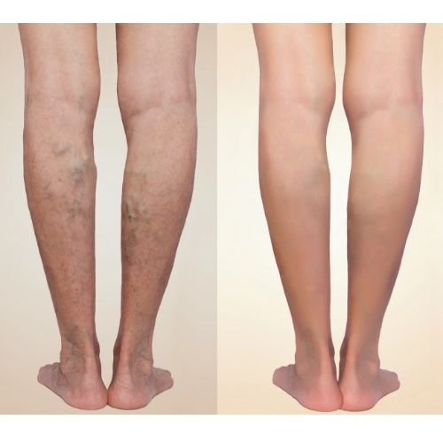 Nutrilegs Forte 3+1 GRATIS